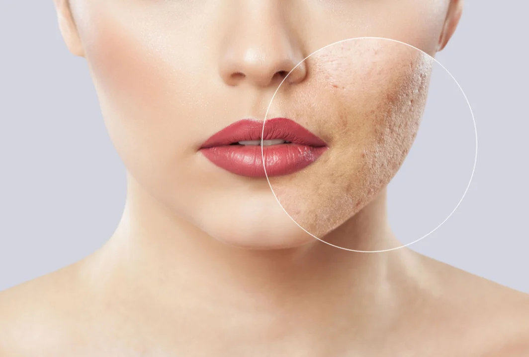 Acne Scars