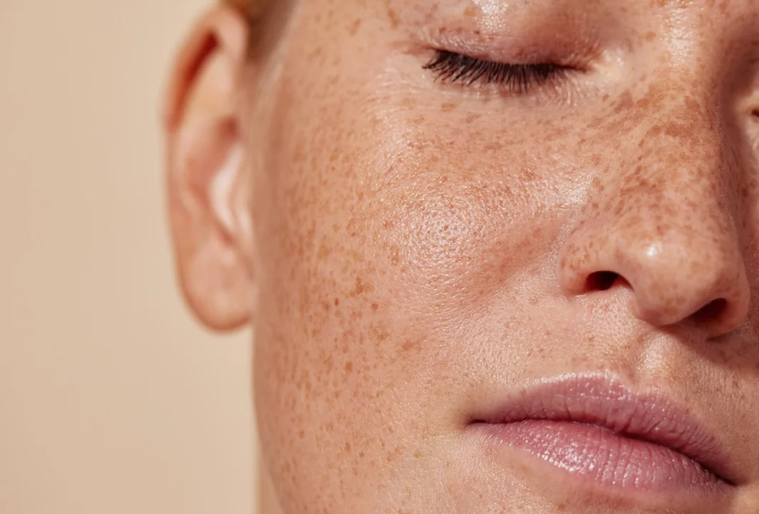 Age Spots
