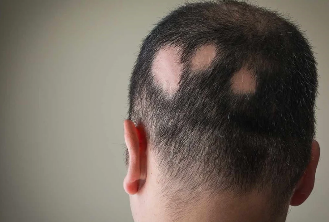 Alopecia Areata