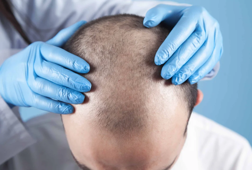 Androgenetic Alopecia