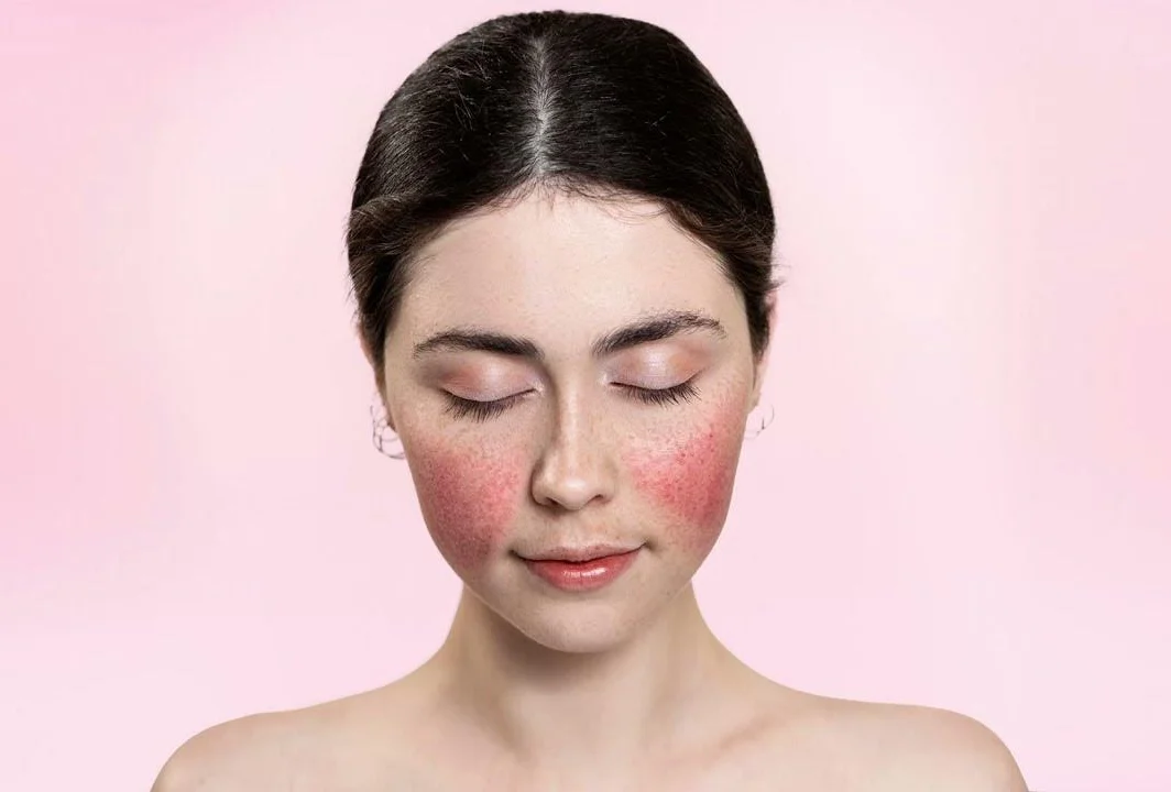 Rosacea