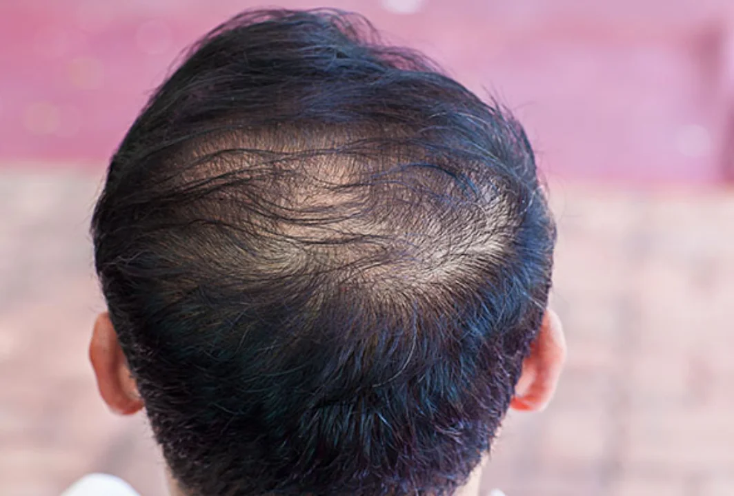 Thinning Hair